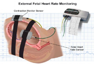 Cardiotocography (CTG)
