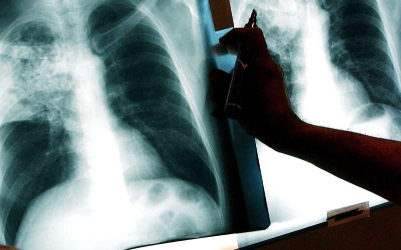 Tips mencegah penularan Tuberkulosis (TB)